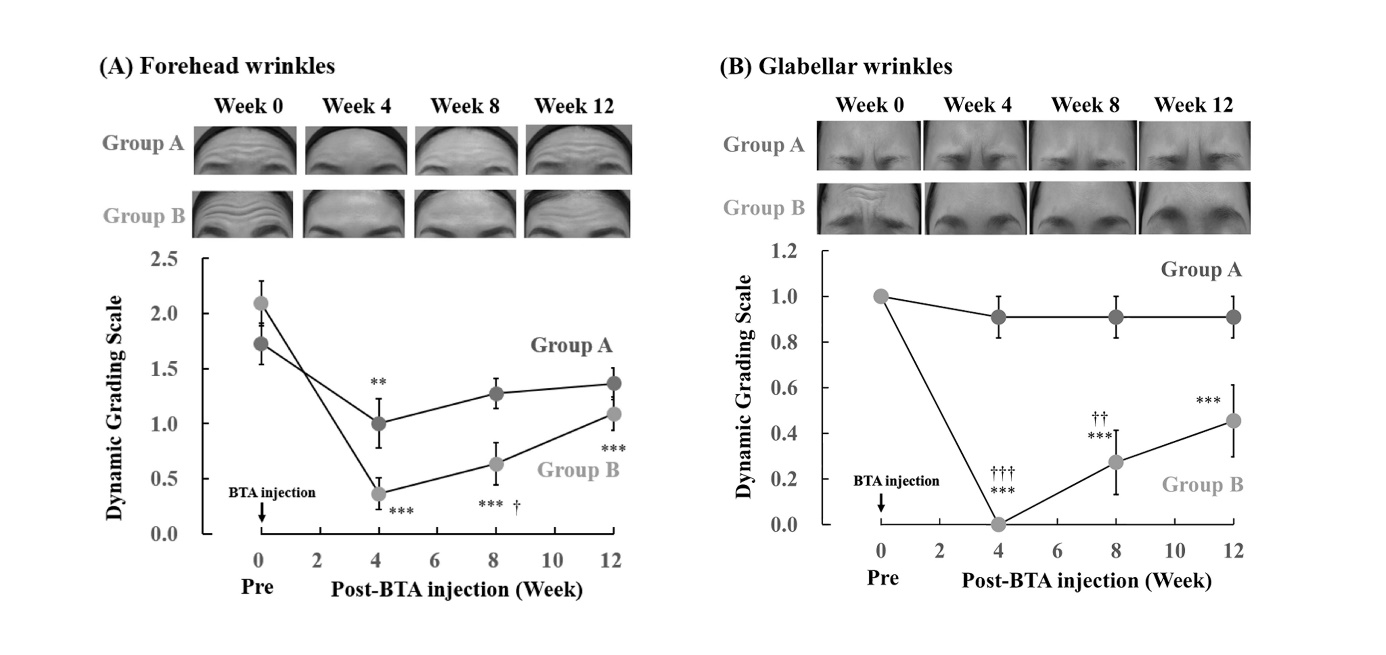 Figure 5: Changes in the severity of forehead (A) and glabellar wrinkles (B) after BTA injection in groups A and B. The photos show the dynamic wrinkle status of the patient’s forehead and glabellar before (week 0) and after BTA injection (weeks 4, 8, and 12) in groups A and B. Wrinkle severity was graded into five levels from 0 to 4. Each value represents the mean ± SEM (n = 11). **_P_ < 0.01 and ***_P_ < 0.001 _vs._ pretreatment week 0 (two-way ANOVA + Tukey’s multiple comparison test). †_P_ < 0.05, ††_P_ < 0.01, and †††_P_ < 0.001 _vs._ group A (two-way ANOVA + Mann–Whitney U test).