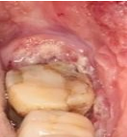 Figure 3: Left Retromolar Trigone on the Right Side, Erythroplasia Extended from Above to Below the Vestibule and the Cheek.