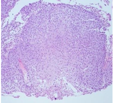 Figure 5: Erythroplasia Dysplasia of the Oral Mucosa.