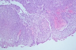 Figure 7: Severe Dysplasia Close of Squamous Cell Carcinoma Oral Mucosa.