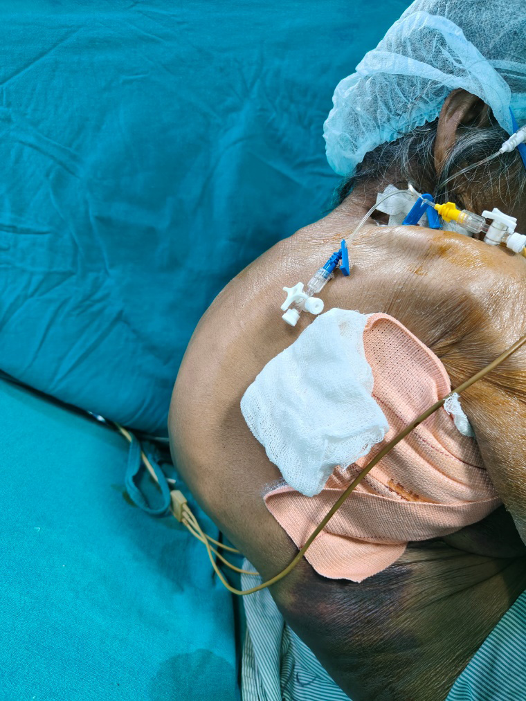 Figure 1: Hyperkyphosis of thoracic vertebrae with bandage in situ, unable to lie flat on bed.