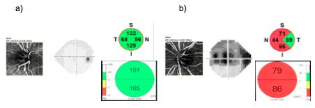 Figure 2: OCT Angiography (Nidek RS-3000 Advance) of a 38-year-old patient with a diagnosis of pigmentary glaucoma, with asymmetric damage, presenting a greater decrease in capillary density, optical coherence tomography parameters and defects of the visual field in left eye. Images a) right eye b) left eye.