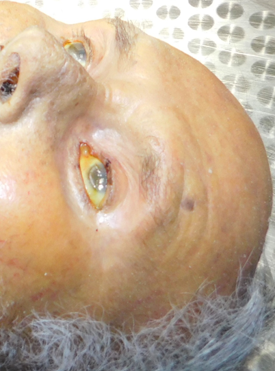 Figure 2: The Sclerae were Also Yellowish.