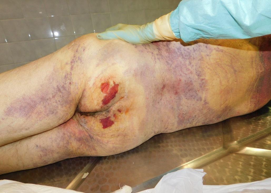 Figure 4: On the Posterior Surface of the Body, in Addition to the Hypostatic Spots, Diffuse Purpuric Lesions were Very Evident, which were Less Evident Anteriorly.