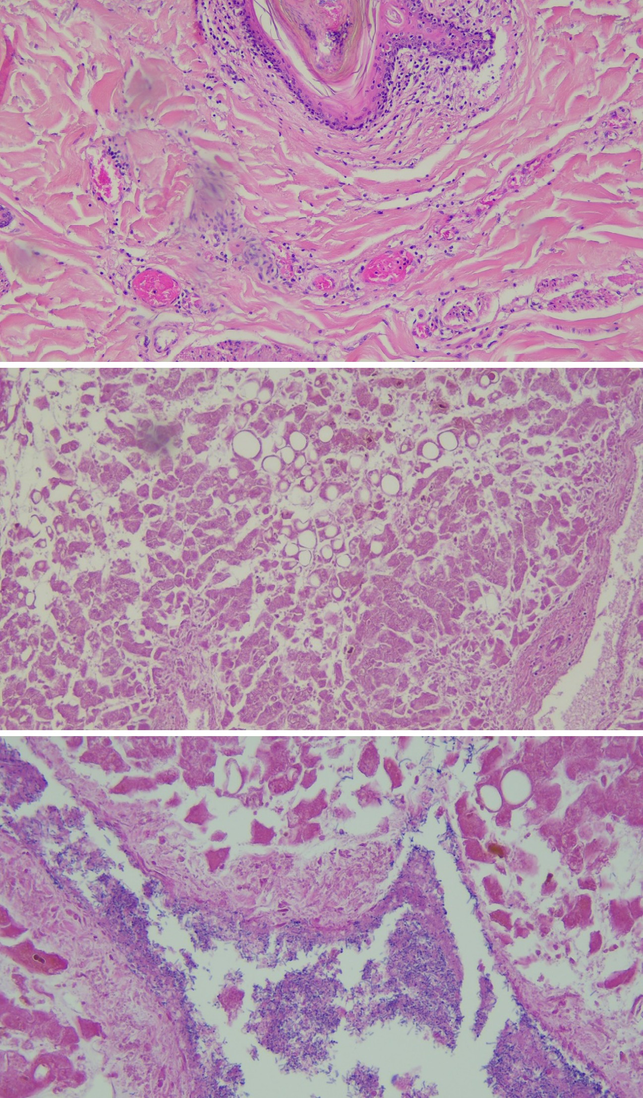 Figure 6: Skin (H&E 40×): In the Skin there were Widespread Microthrombi in the Dermal Vessels.