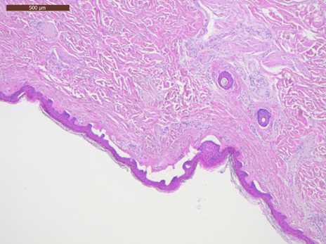 Figure 4: Subepidermal Blistering and Dermal Autolysis.