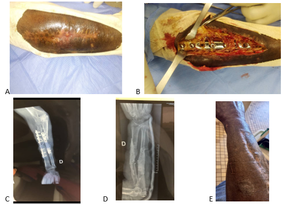 Figure 1: ** Chronic Screw-Plate Infection of Both Forearm Bones.