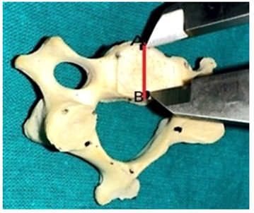 Figure 1: Showing the length of the vertebral body of the Typical Cervical Vertebrae.