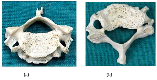 Figure 11: Showing the Osteophytes in the Typical Cervical Vertebrae.