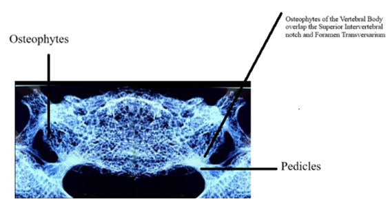 Figure 12: Radiological image of osteophytes overlapping the superior intervertebral notch.