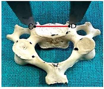 Figure 3: Showing the Superior width of the vertebral body of the Typical Cervical Vertebrae.