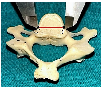 Figure 4: Showing the Inferior width of the vertebral body of the Typical Cervical Vertebrae.
