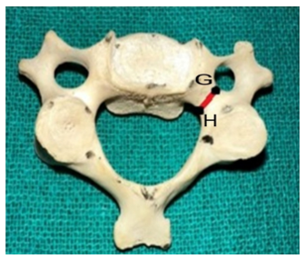 Figure 8: Showing the Width of the Pedicle.