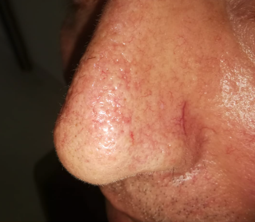 Figure 1: Keratotic papule with well-defined border and slightly atrophic center on the nose.