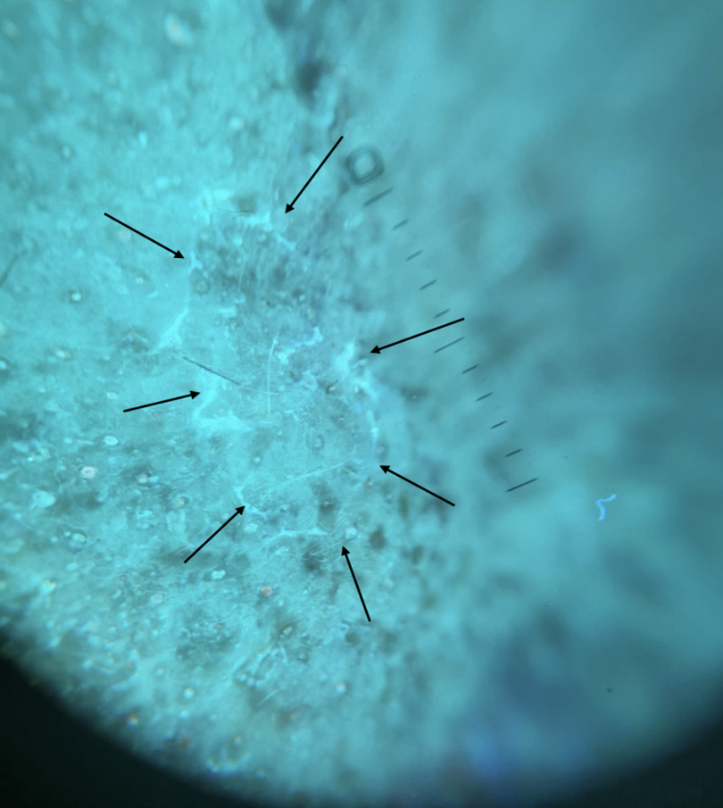 Figure 2: UVF dermoscopy (DermLite DL5) revealed a white-blue peripheral keratotic tract with double free edges.