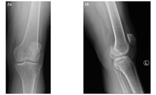 Figure 1: Left knee AP view (1a) and lateral view (1b) demonstrates a tibial plateau transverse faint lucent line with surrounding callus formation.