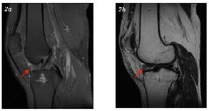 Figure 2: MRI of the left knee. Sagittal proton density fat saturation (2a), sagittal T2 non-fat saturation (2b) demonstrate the intermediate to low signal intensity soft tissue nodule near the tibial insertion of the anterior cruciate ligament. The patient was managed conservatively with medical treatment and physiotherapy aimed at improving range of motion and muscle strength (Figure 3).