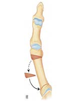 Figure 1: Bipolar Osteotomy According to Schnepp.