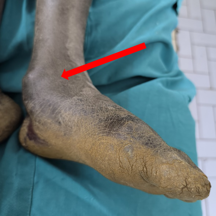 Figure 1: Preoperative photograph of the patient showing the deformity of the left foot (Red arrow).