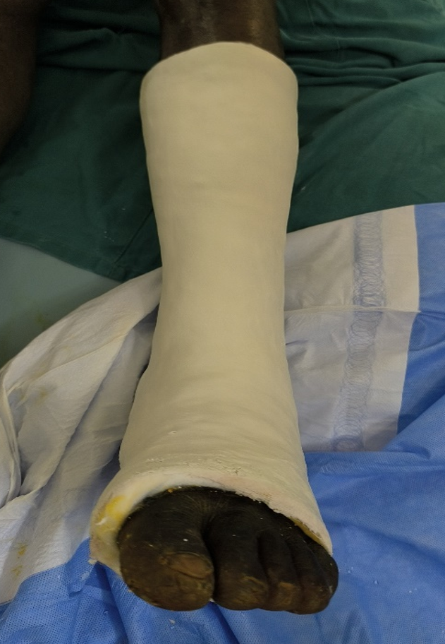 Figure 3: Postoperative photograph of the left foot showing the cruro-pedal cast in place after reduction and pinning.