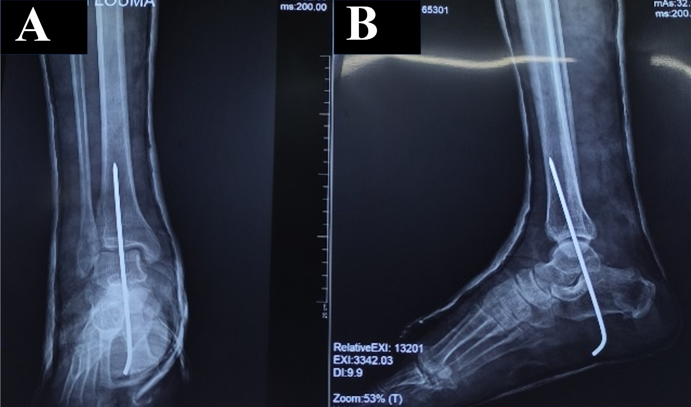 Figure 4: Standard postoperative radiographs of the left ankle, front (A) and side (B) after reduction and pinning.
