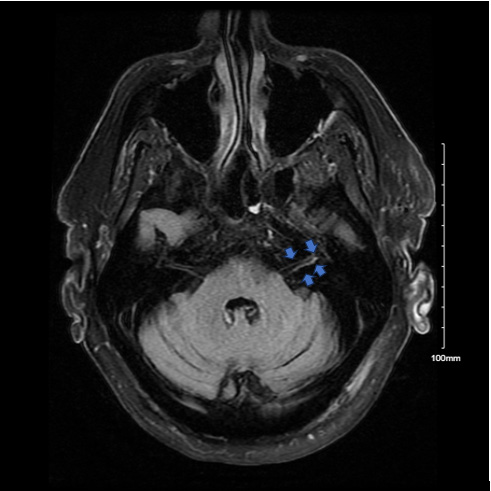 Figure 1: T2 FS Flair Post AX Post MRI Brain and Internal Auditory Canal (IAC) with and without Contrast Showing Abnormal Enhancement of the Left 7th and 8th Cranial Nerves, Indicated with Blue Arrows.