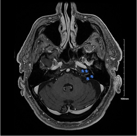Figure 2: Axial MP Rage Post MRI Brain and Internal Auditory Canal (IAC) with and without Contrast Showing Abnormal Enhancement of the Left 7th and 8th Cranial Nerves , Indicated with Blue Arrows. Competing Interests Authors declare that no competing interests