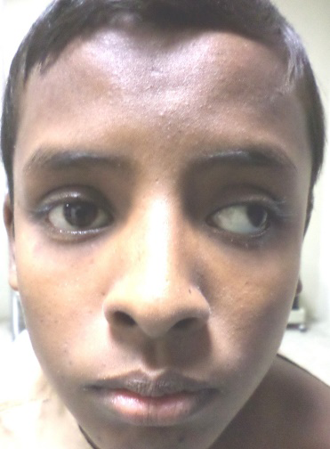 Figure 1: Outward deviation of left eye.