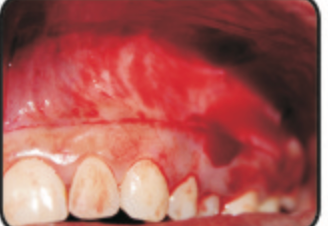 Figure 4: Partial thickness tissue dissected with the frenum intact.