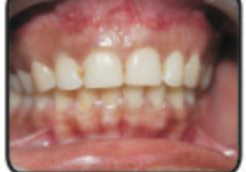 Figure 7: Comparison of preoperative view (on the left) and 6 months postoperative on the right showing significant reduction in gingival display, and maintenance of philtrum.