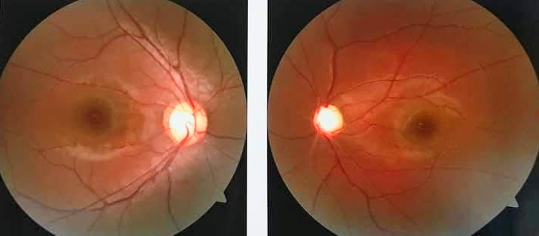 Figure 1: Small optic disc and large cupping (left eye).