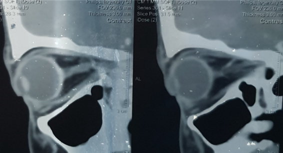 Figure 4: Focal atrophy of left optic nerve.