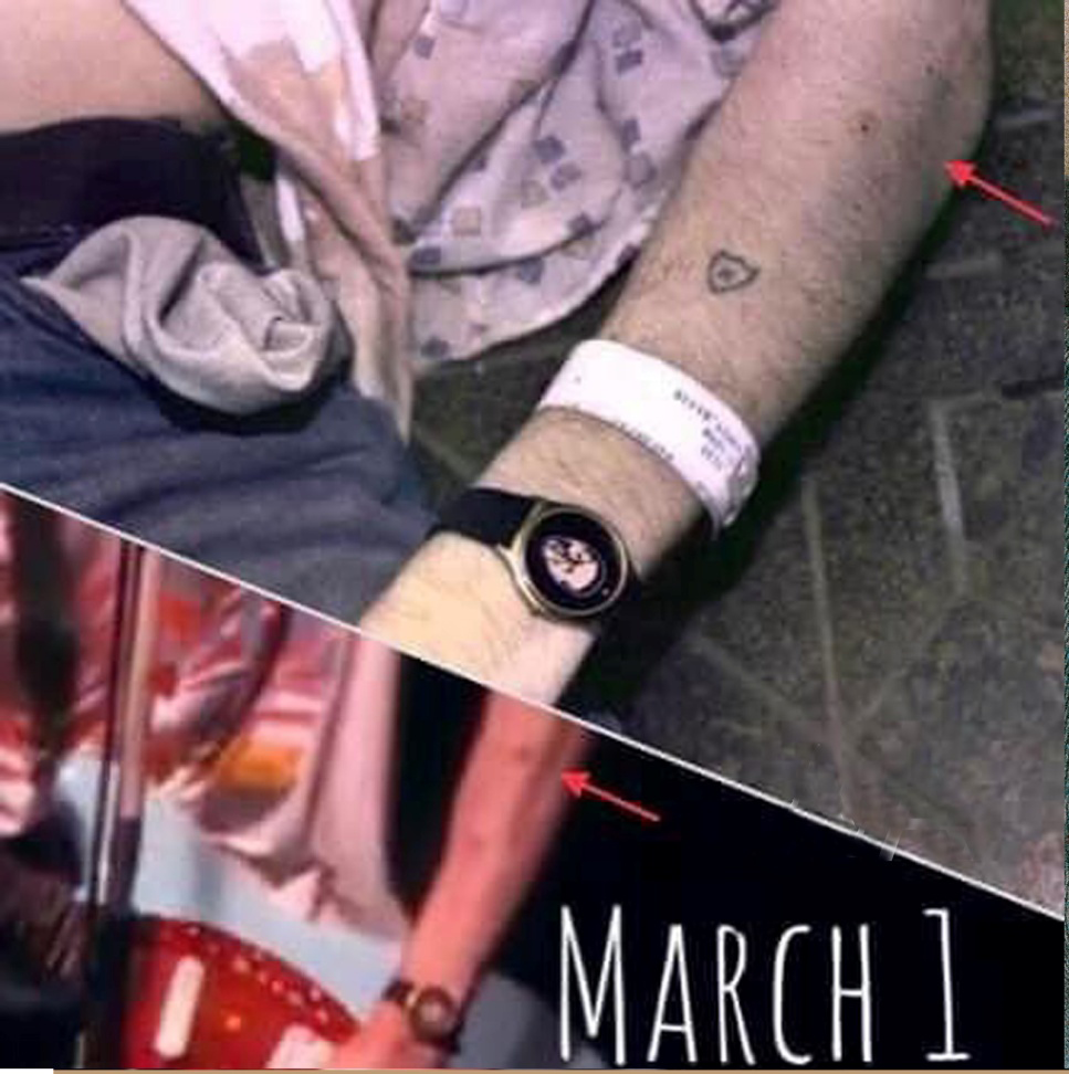 Figure 13: Top. Cropped image from image 15380001 (Figure 1C), showing Cobain’s left dorsal forearm; the arrow points to a punctate wound on his forearm. Bottom. Image extracted from a video tape of Cobain in his last concert on March 1, 1994, in Munich, Germany, more than a month before his death. The red mark on his proximal forearm is likely a bruise that has nothing to do with the punctate wound at that same location on his left arm at the death scene. Image found on the internet by author MW. Image’s original source is unknown.
