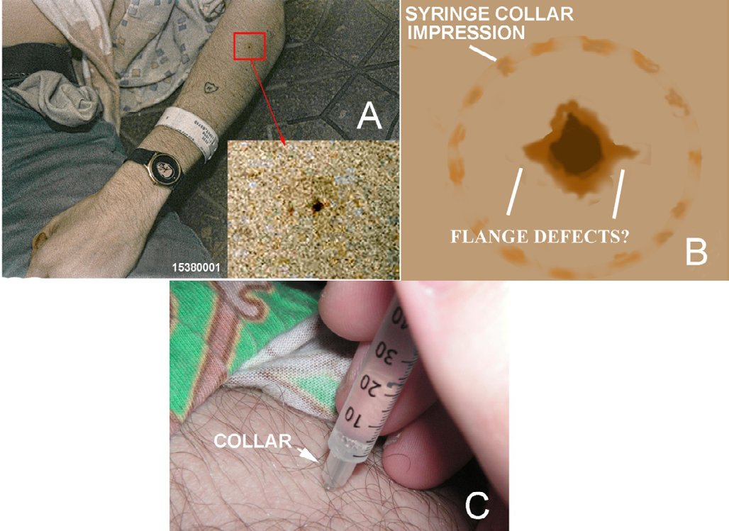 Figure 15: A. Likely hypodermic needle wound on Cobain’s left dorsal proximal forearm; inset: an enlargement of the punctate wound showing it is surrounded by a circle of dermal discoloration. Image 15380001 (Figure 1C) from the SPD 2014 release. B. Graphic interpretation of the wound and its surrounding circle of skin discoloration; the presence of flange defects associated with the wound is uncertain. Graphic by author BB. C. Intramuscular injection using a collared syringe showing the collar almost touching the skin; image from Wikipedia [35].
