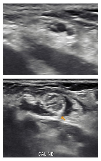 Figure 4: If the nerve is under long segmental compression from scar tissue or fibrosis, I will increase the volume injected by adding 5 – 20ml of saline. This is shown in figure 5. The volume I use depends on the site and the amount of fibrosis I need to treat. I use ice cold saline as it has a local anaesthetic effect, and the cold induced vascular spasm helps prevent bleeding from the soft tissues being hydrodissected.