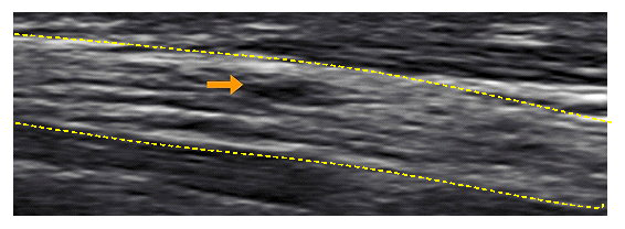 Figure 6: The consequence of sensory and motor loss after injection of various agents into peripheral nerves has been well documented. Nerve with large fascicles are more likely to sustain fascicle injury than nerve with multiple fascicles where it is more difficult to inject into the fascicle. Injecting into a fascicle causes mechanical destruction of the fascicular architecture and sets into motion a cascade of pathophysiologic changes. These include inflammation, cellular infiltration, axonal degeneration, and others, all leading to nerve scaring. The extent of actual neurologic damage after an intrafascicular injection can range from minimal structural damage to severe axonal and myelin degeneration. This leads to increased excitability and the development either of acute or chronic neural pain.