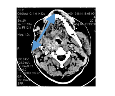 Figure 2: Computed tomography of the facial mass (axial section).