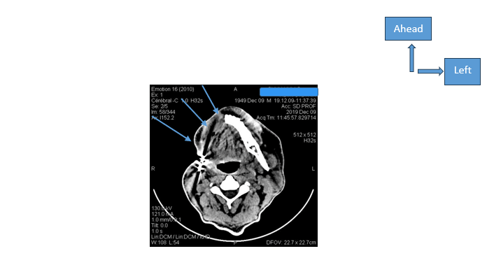 Figure 5: Computed tomography of the facial mass (axial section).