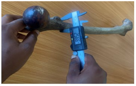 Figure 4: Measurement of proximal sagittal diameter of femur.