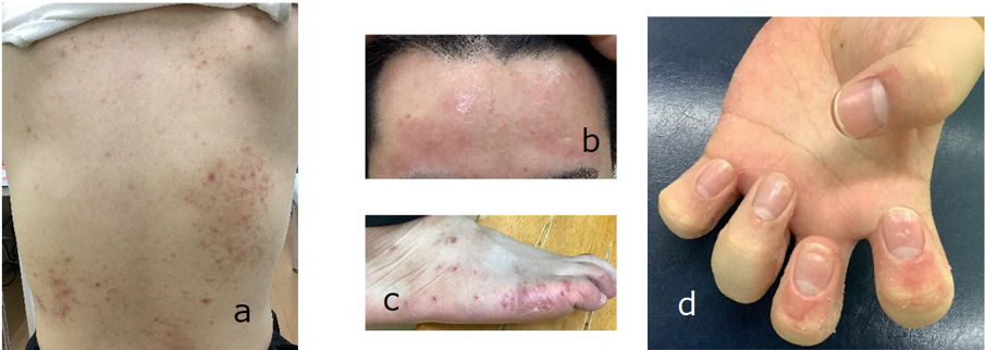 Figure 1: Erythema and papules on the trunk, forehead, and extremities (a-c), and nail deformities (d).