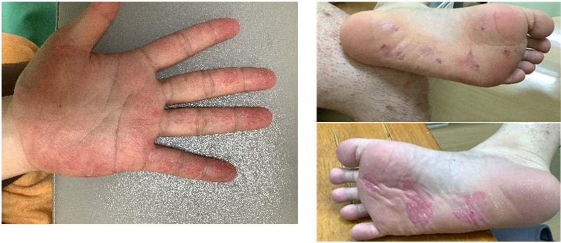 Figure 3: Erythema and epidermal desquamation on the palmar and plantar surfaces.