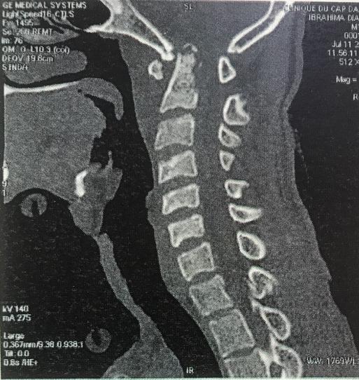 Figure 2: The MRI with a painful thickness of paravertebral soft tissue with a mass- medullary effusion and signs of myelopathic upper spinal cord injury. The biological assessment revealed an inflammatory syndrome with accelerated ESR, a positive CRP and a lymphocytosis without counting leukocytosis. HIV serology was negative with an intradermal positive at 18 mm. Gen Expert was positive in cerebrospinal fluid. The biopsy was not performed knowing that it was risky. After a 24-hour hospitalization, the patient presented, a tetraplegia associated with dyspnea and a fever of 38°3