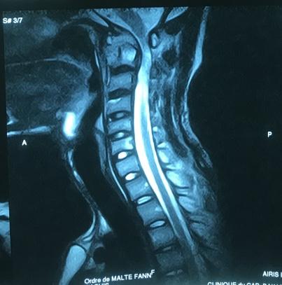 Figure 4: Posterior C1 C2fusion by surgical lacing Two weeks after a quadruple antituberculous chemotherapy (rifampicin, isoniazid, pyrazinamide and etambutol) was then initiated for three months followed by dual therapy for nine months.Because of the importance of the bone and medullary lesions, a C1 C2 lacing was performed (Figure 4) associated with a plaster cast thoracocervical immobilization. After the first phase of antibacillary treatment (2 months) the motor deficit disappeared completely.