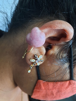 Figure 1: Dome-shaped keloid on the upper ear near a piercing site.