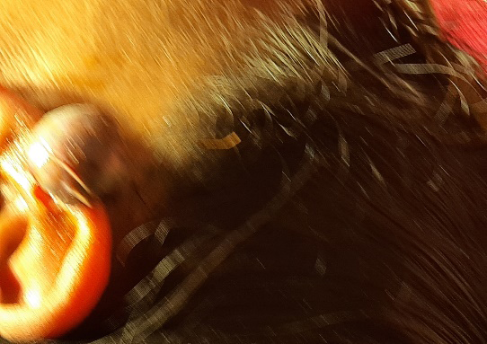 Figure 2: Small, rounded keloid on the lower ear near a piercing site.