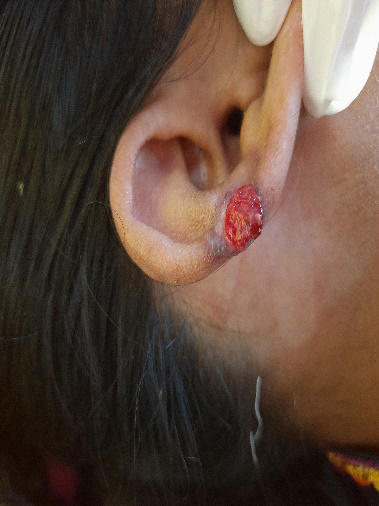 Figure 5: Raw, circular wound area on the lower ear following removal of a lesion near a piercing site.