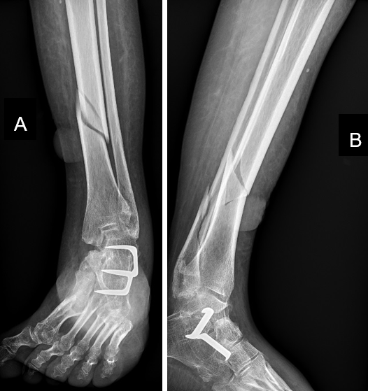 Figure 1: Anteroposterior (A) and lateral (B) radiographs of the left leg showing a spiral fracture of the distal third of the left tibial diaphysis associated with a supratubercular fracture of the lateral malleolus.