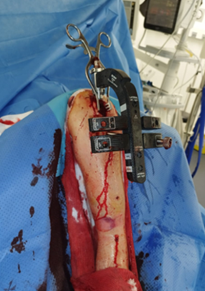 Figure 2: Placement of the locked humeral nail within the tibial medullary canal.