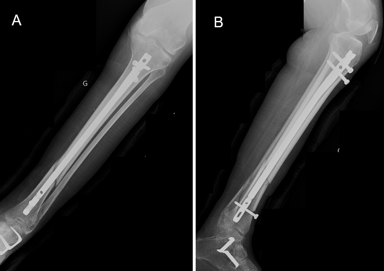 Figure 4: Six-week postoperative radiographic control (anteroposterior and lateral views).
