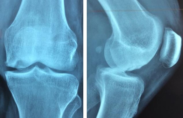 Figure 1: Aspect of the lesion on standard X-ray.